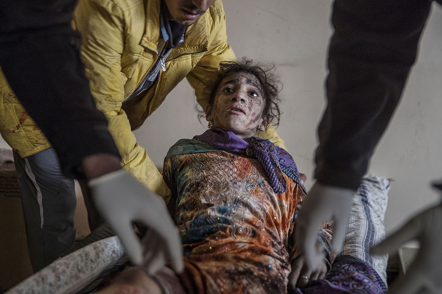 foto : magnus wennman : tolvåriga wijdan moofik har skadats svårt. såren är överallt. sjukvårdare pressar med händerna över de värsta skadorna för att hejda blödningen. fältsjukhuset vid irakiska frontlinjen i mosul. hit kommer skadade och dödade civila och militärer från striderna i mosul. de som inte avlider får akut sjukvård och körs vidare till sjukhuset i erbil.